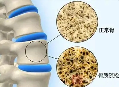 骨质疏松不是老年病专利！这些 “隐形杀手” 正在啃食你的骨头