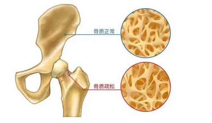 肥胖与骨质疏松：被忽视的健康危机，骨密度仪来守护 ！