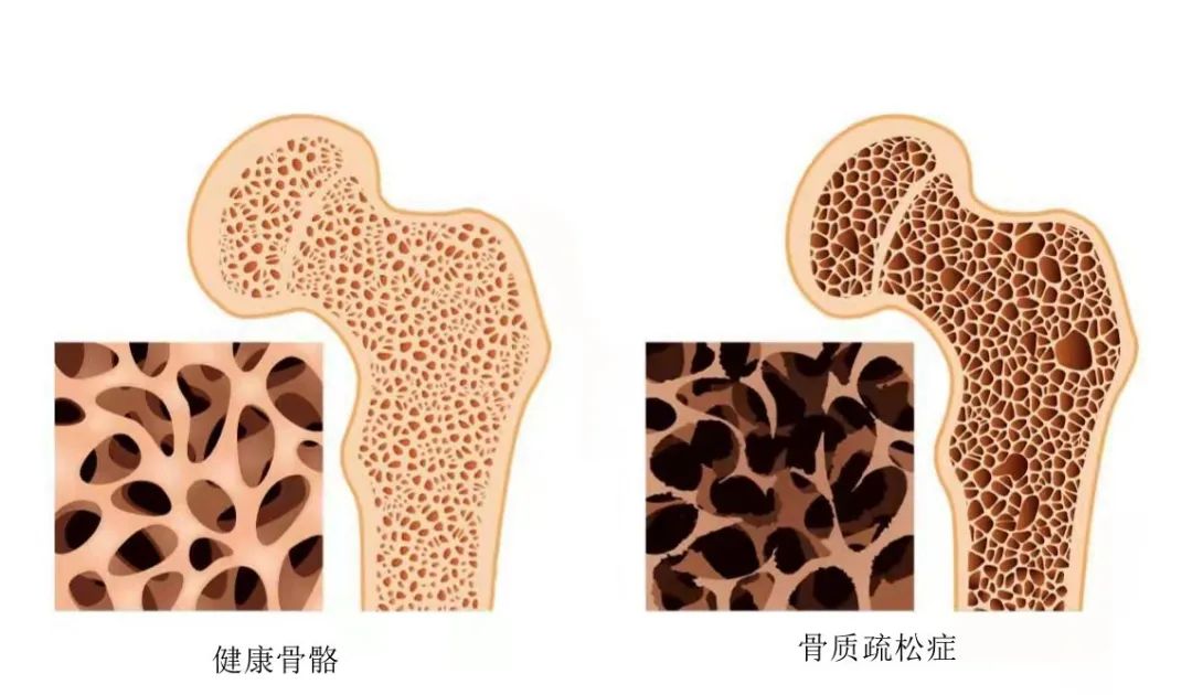 骨头悄悄 “变脆”？身体发出的这些信号，别等疼了才重视