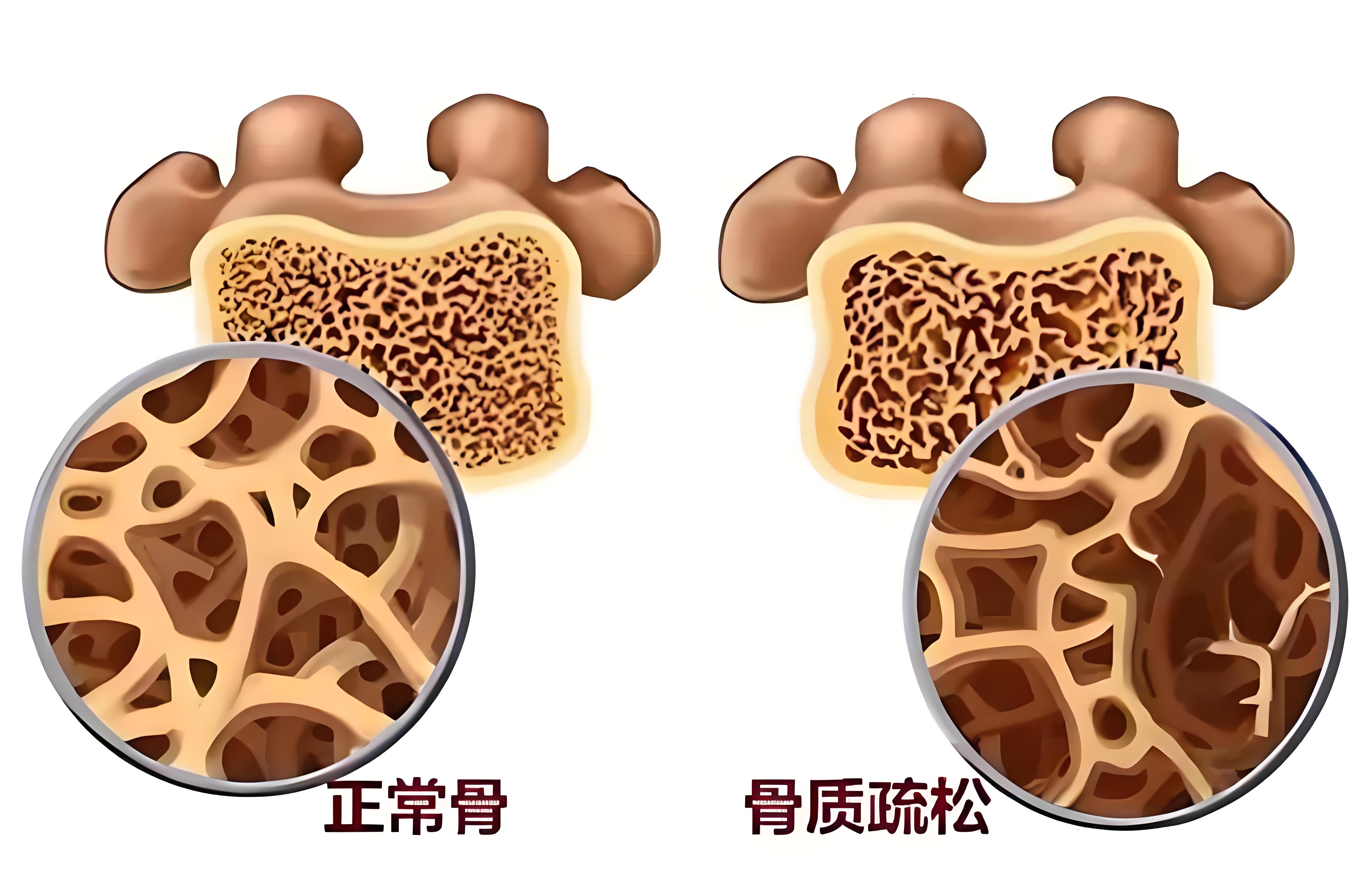 骨密度：不止是老年人要关注，它对全身健康的影响超乎想象