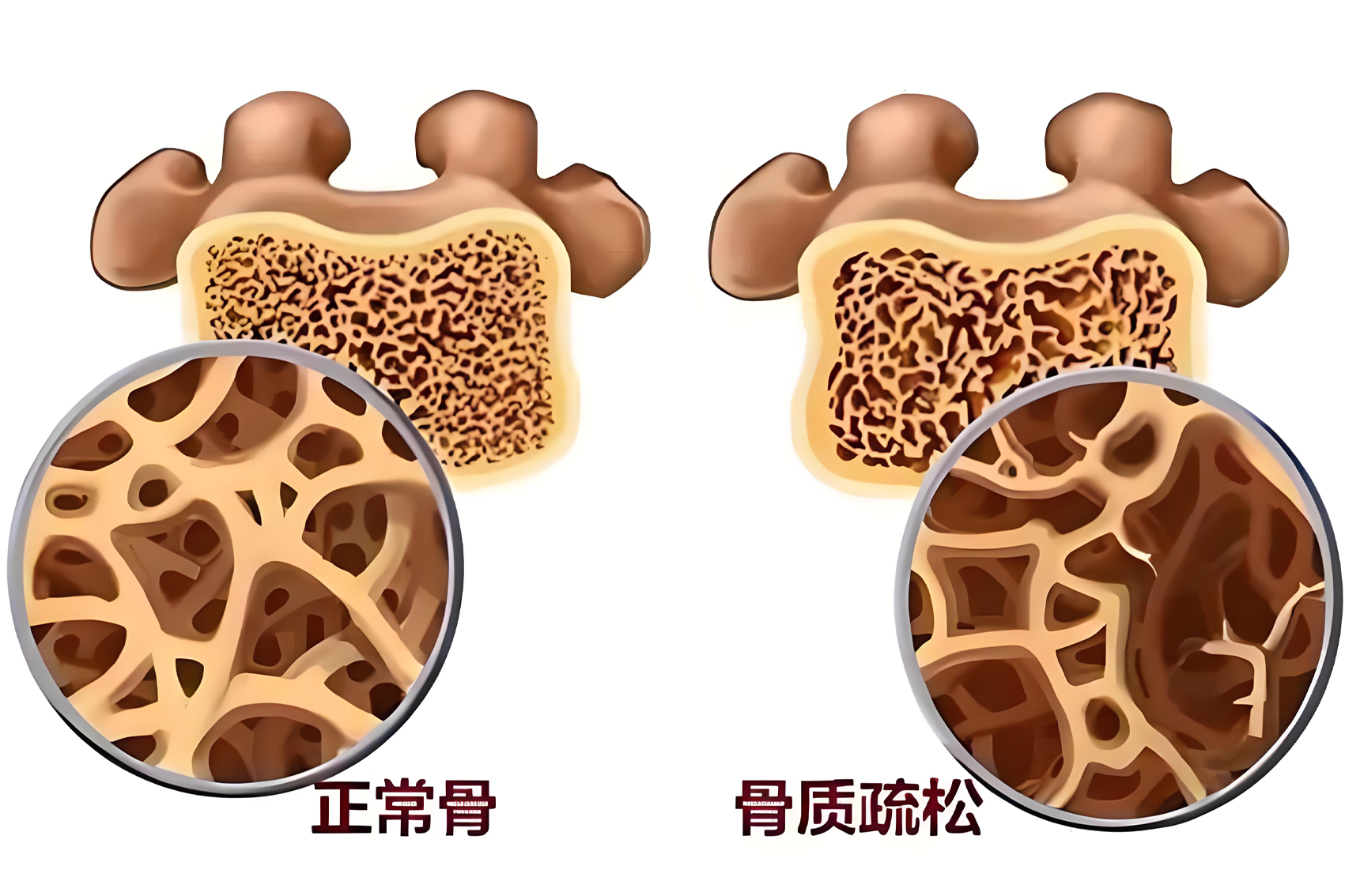 骨密度：不止是老年人要关注，它对全身健康的影响超乎想象