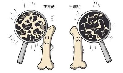 骨密度 T 值和 Z 值有何不同?辛宇弘医疗超声骨密度仪来解答 骨密度 T 值和 Z 值有何不同?辛宇弘医疗超声骨密度仪来解答