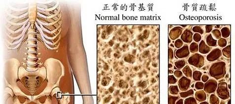 双能 X 射线骨密度仪：筑牢骨质疏松防治的 “检测防线”