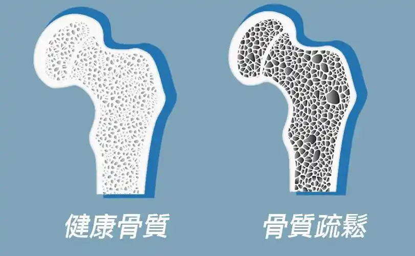 哪些骨骼麻烦，藏着骨密度的 “小秘密”