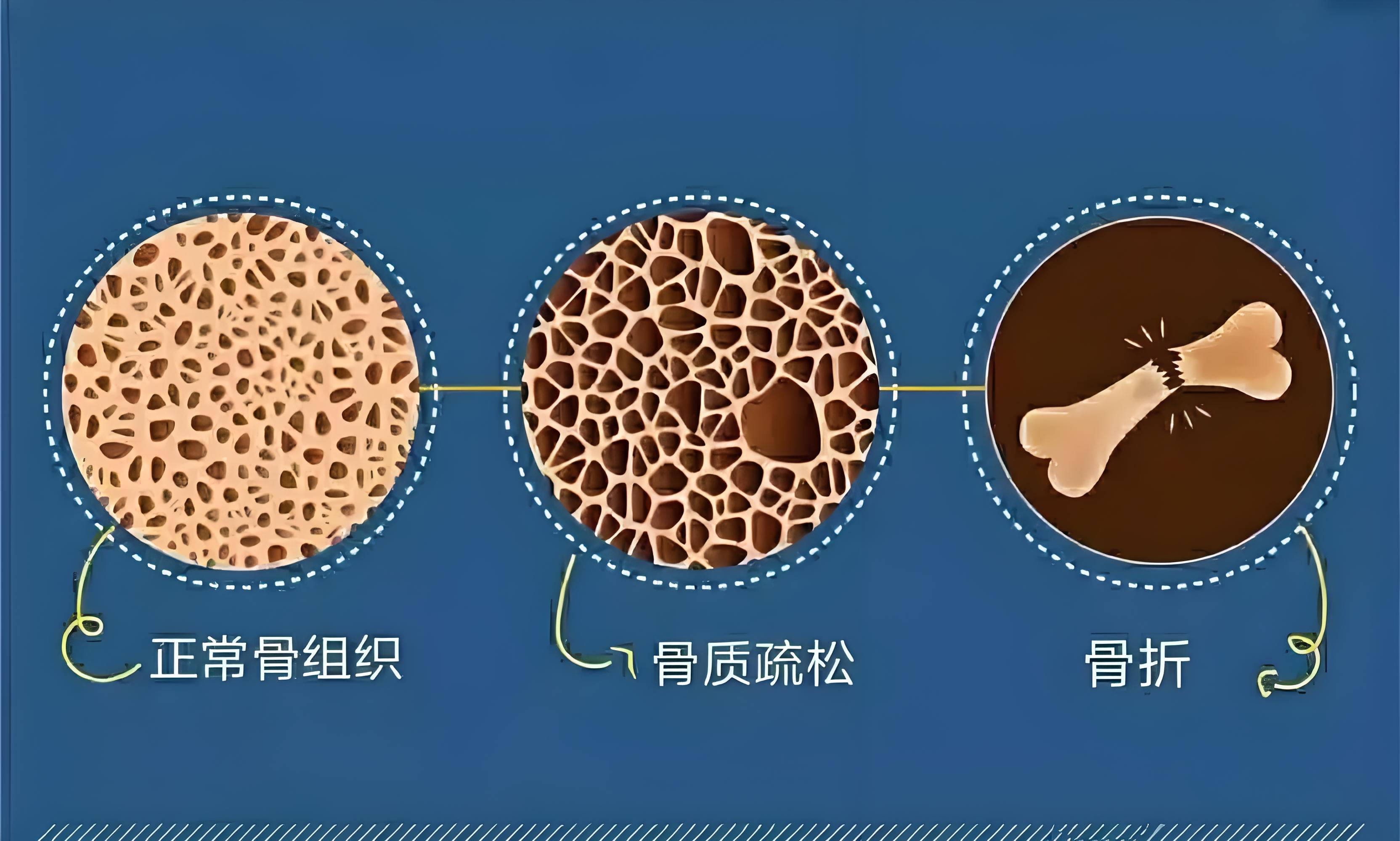 青年养骨、老年护骨，双能 X 射线骨密度仪：不同阶段，同样守护