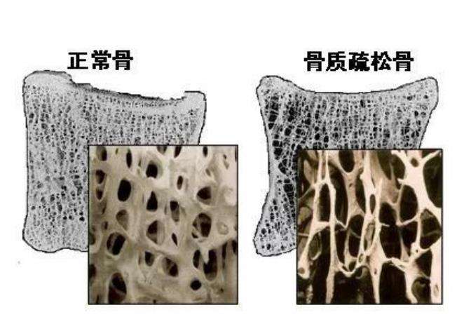 沉默的“骨脆脆”：骨质疏松离你没那么远